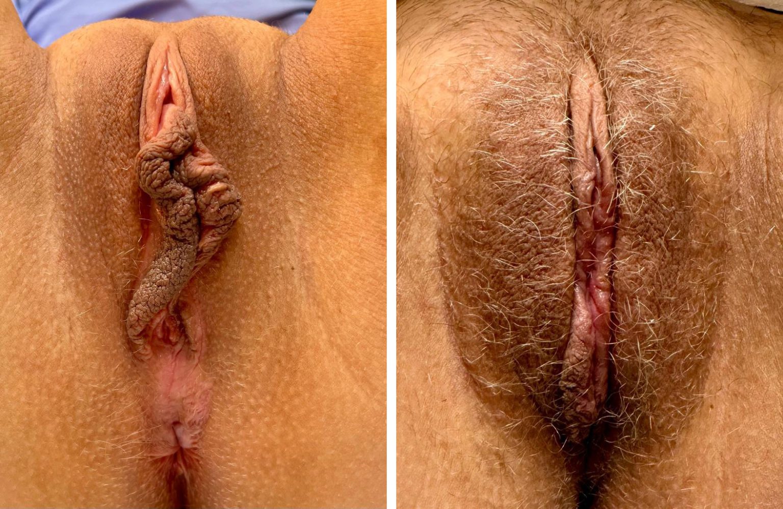 mergedBeforeAfterImage