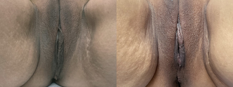 mergedBeforeAfterImage