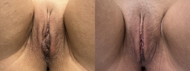 mergedBeforeAfterImage