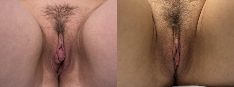 mergedBeforeAfterImage