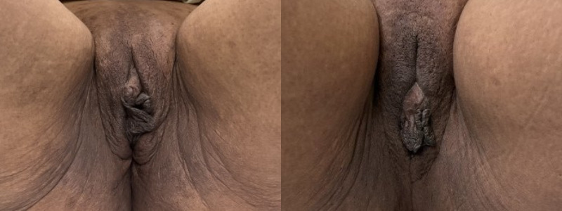 mergedBeforeAfterImage