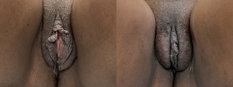 mergedBeforeAfterImage