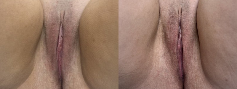 mergedBeforeAfterImage