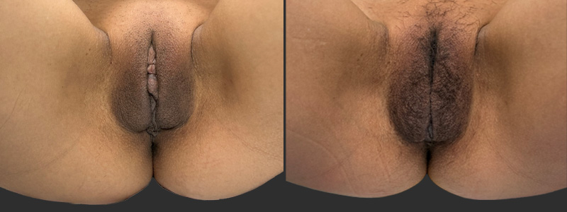 mergedBeforeAfterImage