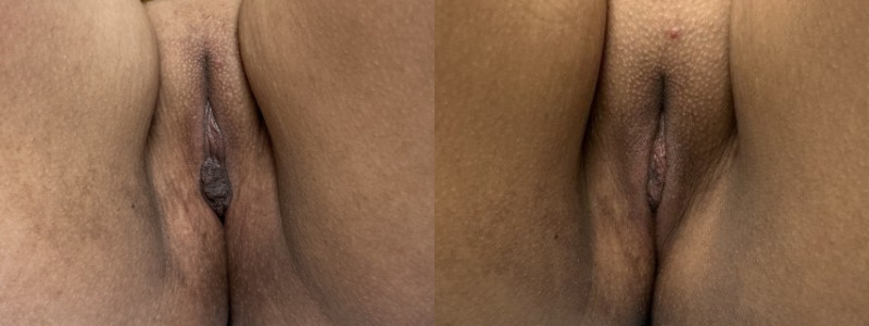 mergedBeforeAfterImage