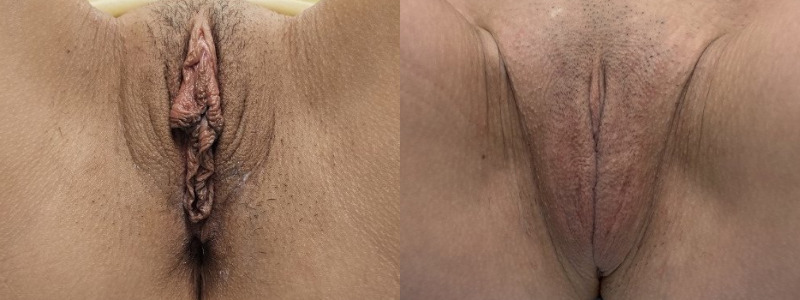 mergedBeforeAfterImage