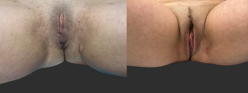 mergedBeforeAfterImage