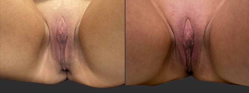 mergedBeforeAfterImage