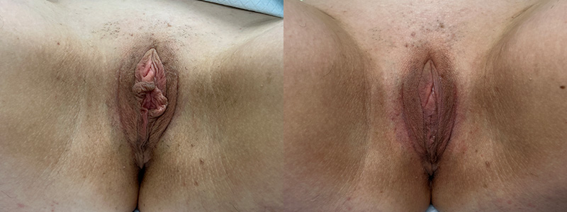 mergedBeforeAfterImage