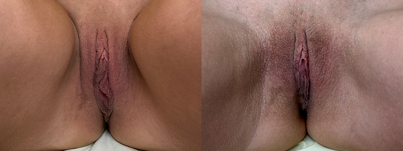 mergedBeforeAfterImage