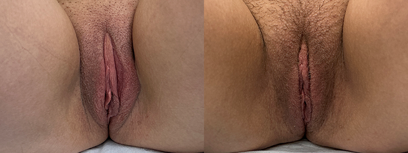 mergedBeforeAfterImage