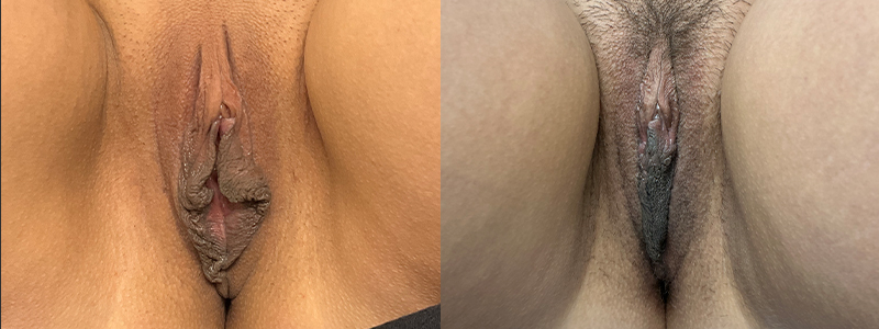 mergedBeforeAfterImage