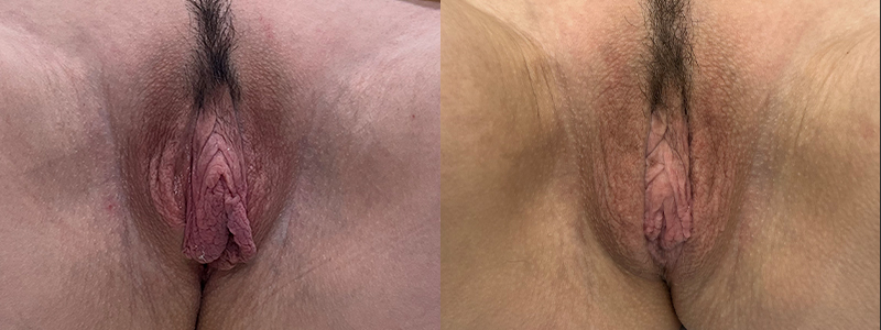 mergedBeforeAfterImage