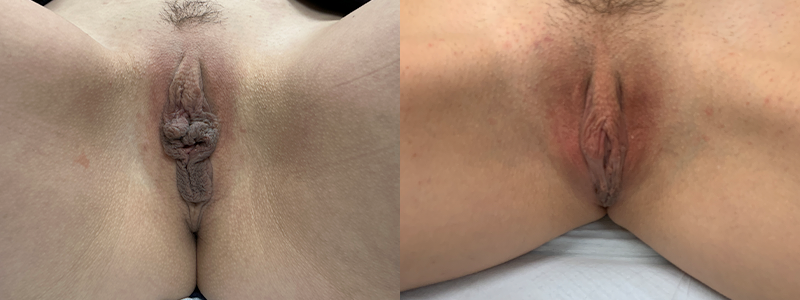 mergedBeforeAfterImage